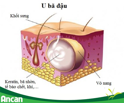 Structure of a sebaceous cyst