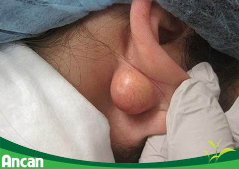 A sebaceous cyst can be disfiguring