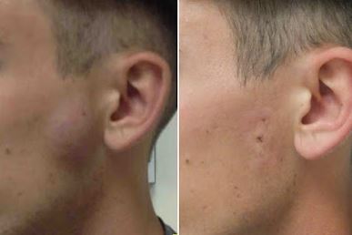 Dấu hiệu nhận biết và nguyên nhân hình thành u bã đậu