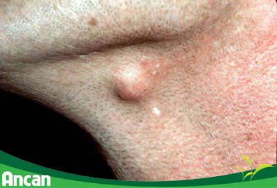 Sebaceous cysts appear on areas that sweat heavily and produce oil
