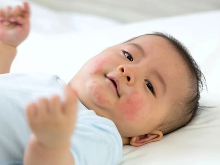 Cow's milk protein allergy in children: how to recognize and handle it