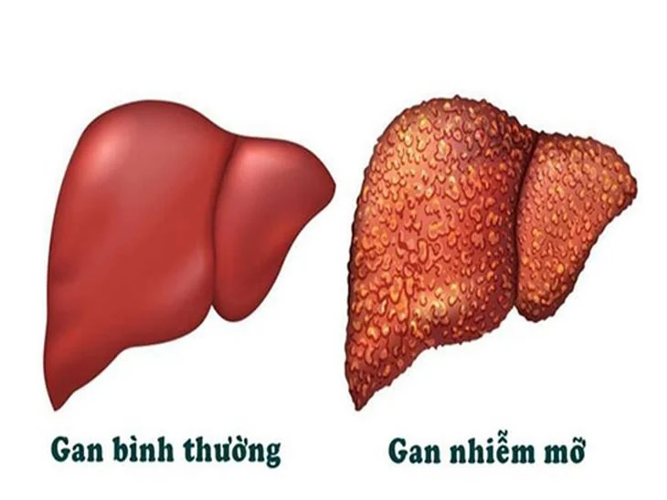 Fatty liver: which tests show how advanced the disease is