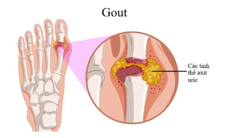 Gout ở người trẻ: nguyên nhân, dấu hiệu và cách kiểm soát
