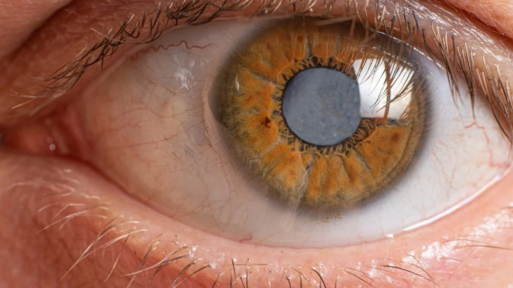 Cataracts in young people: risk factors you should know