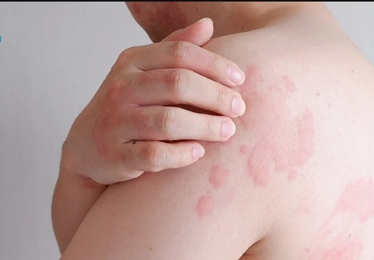 Hives: usually harmless, but know the emergency warning signs