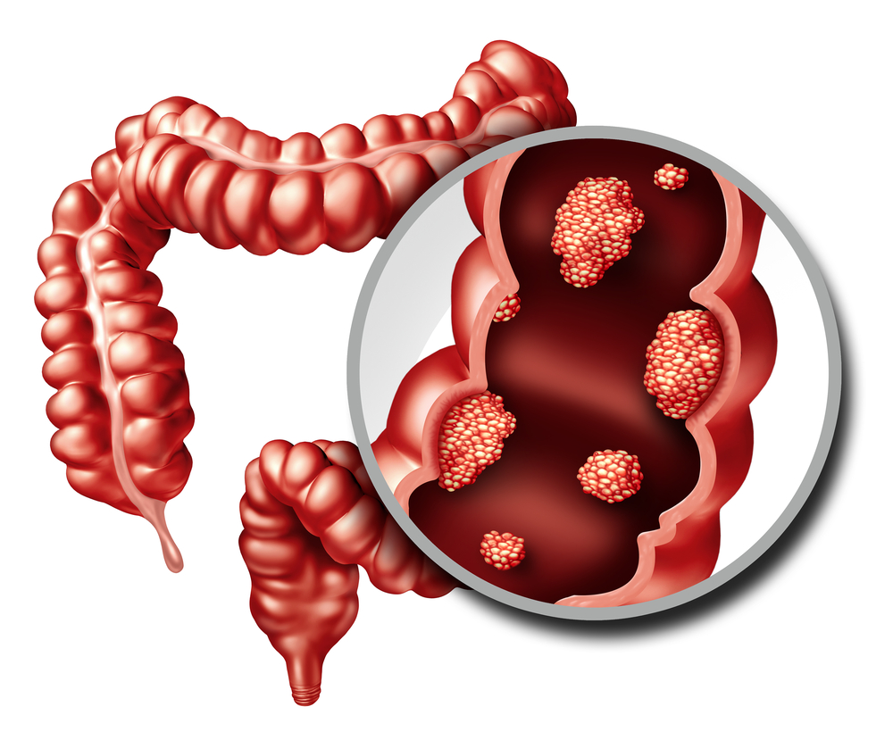 Colitis