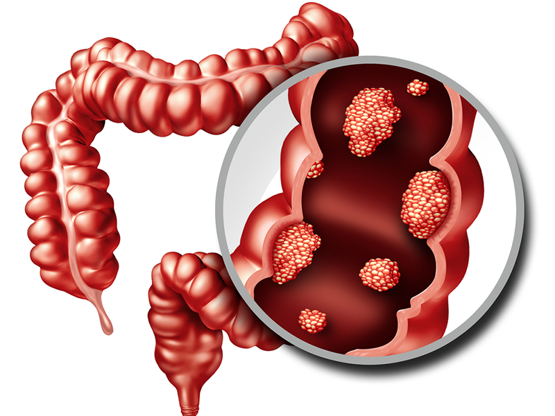 A New Japanese Approach to Ulcerative Colitis