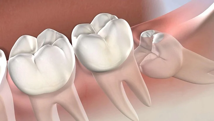 Impacted wisdom teeth: common complications and when to extract