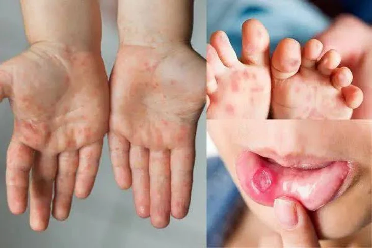 Hand, foot and mouth disease in children: signs and when to seek care