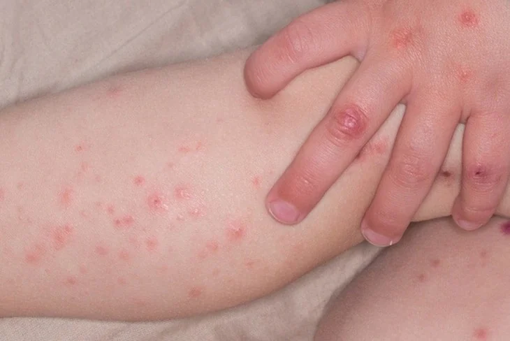 Hand, foot and mouth disease in children: signs and when to seek care