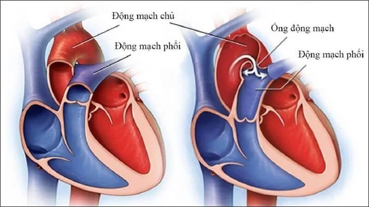 Tim bẩm sinh ở trẻ: 4 biểu hiện cha mẹ không nên bỏ qua