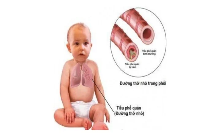 Acute bronchiolitis in children: early recognition and proper care