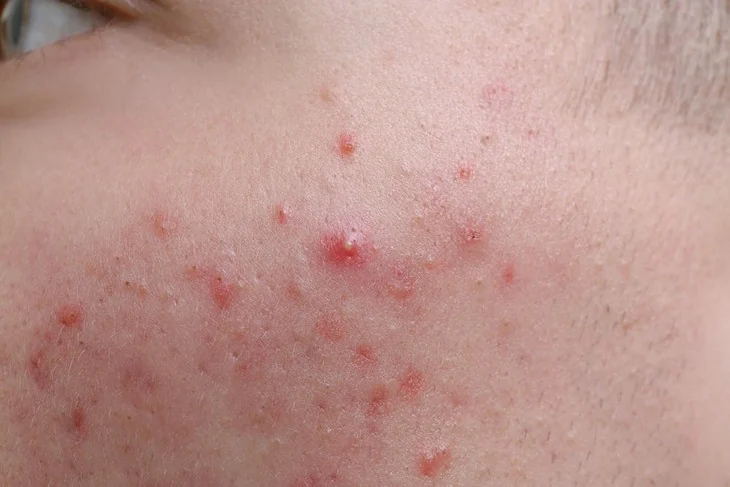 Rosacea: spotting it early and skin care to limit flare-ups
