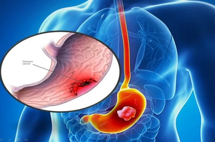 Stomach cancer: 6 signs to get checked early and who is at risk