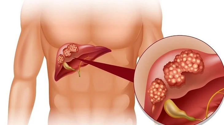 How does hepatitis C spread? Is sharing meals or hugging safe?