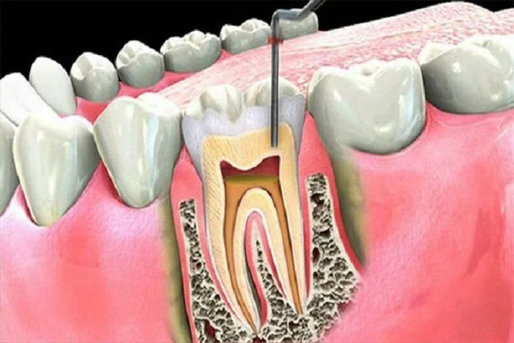 Untreated periodontitis: how it affects your teeth over time