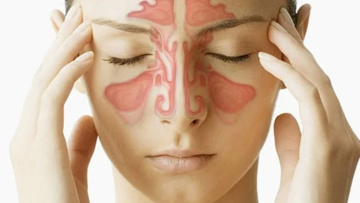 Recurring sinusitis: 5 risk factors and how to prevent it
